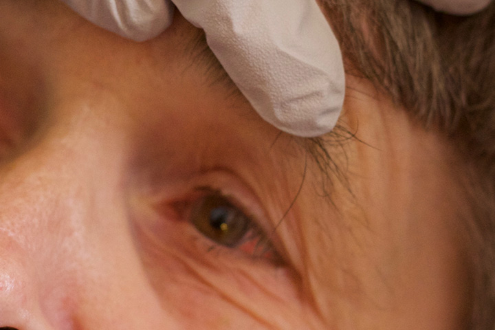Alison's eye is slightly red