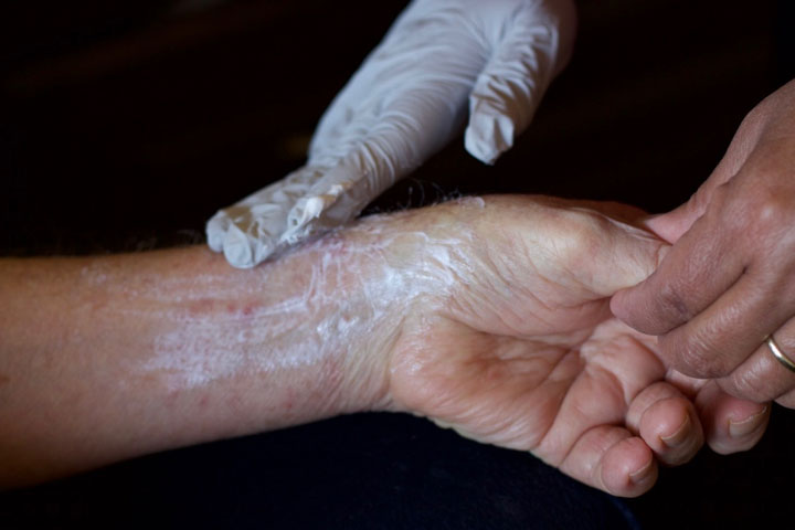 Gloved hand spreading cream on to an arm
